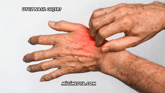 Uyuz Nasıl Geçer?